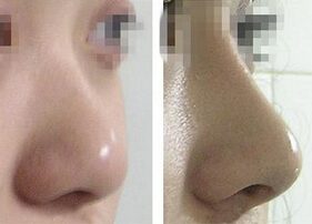隆鼻歪了该如何补救