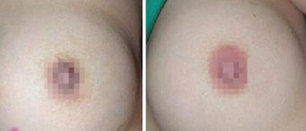怎样把乳晕变红呢