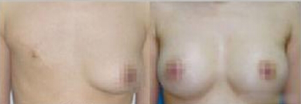 再造乳房有疤痕明显吗