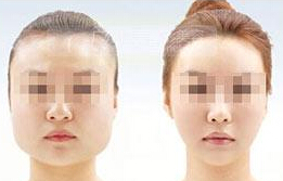 瘦脸针效果咋样