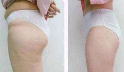 一般溶脂针多少钱