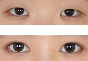 绵阳开眼角要多少钱