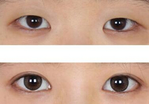 开眼角眼睛能变大吗
