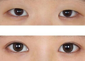 开眼角注意事项包括哪些