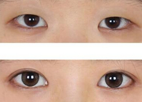 开眼角多少钱恰当
