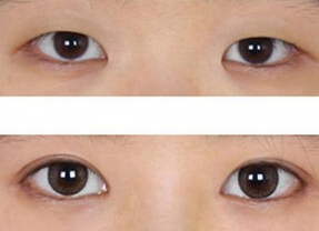 开眼角手术适合哪些人