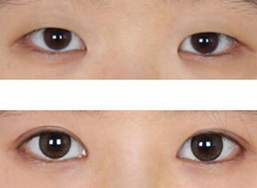 开眼角术后要怎么护理