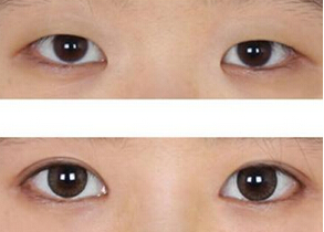 开眼角手术有用吗