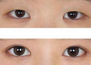 开眼角一般多少钱