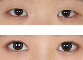 开眼角真可以让眼睛变大吗
