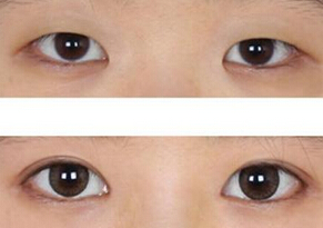 成都割双眼皮哪里好