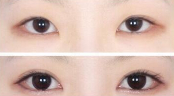 开眼角价格很高吗