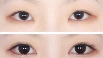 开眼角注意事项是什么
