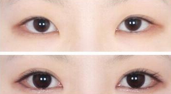 怎样割双眼皮才自然