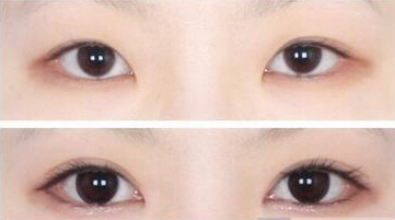 成都开眼角效果好的医院是哪家