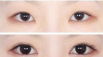 开眼角多少钱合适