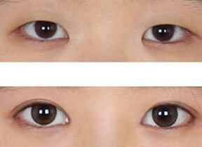 成都做开眼角多少钱