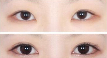 成都成美开眼角