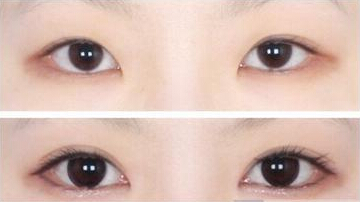 成美割双眼皮