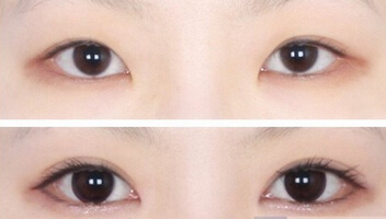 成都成美整形割双眼皮