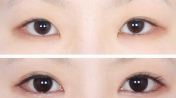 成美整形割双眼皮