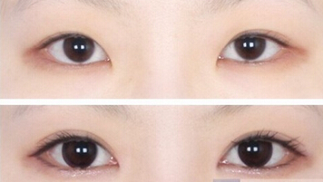 成美整形医院开眼角