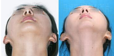 颧弓缩小有哪些方法
