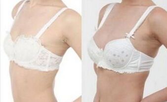 假体隆胸会导致乳房疾病吗