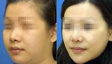 面部肥胖怎么减