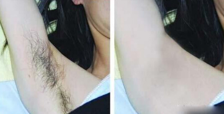 冰肌脱毛要脱几次才能干净