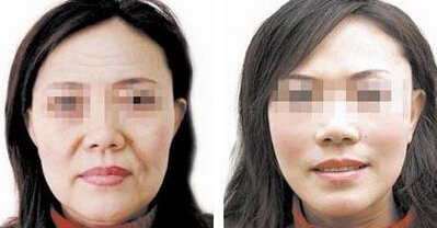 面部拉皮除皱的效果怎样