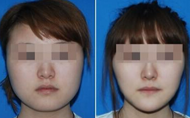 面部吸脂有什么优势