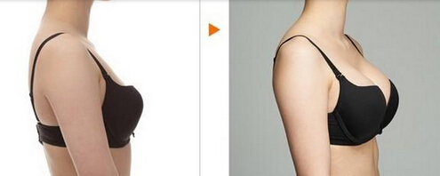 脂肪丰胸好不好