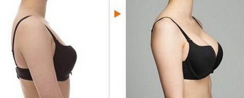 胸部小怎么改善