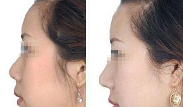 膨体隆鼻可以保持多久