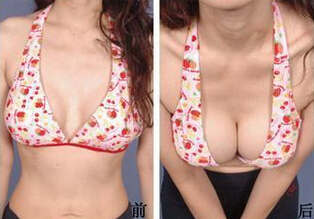 绵阳什么方法丰胸好