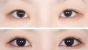 成美割双眼皮多少钱