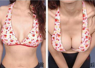 丰胸手术的护理很麻烦吗