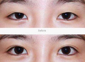 双眼皮埋线多少钱
