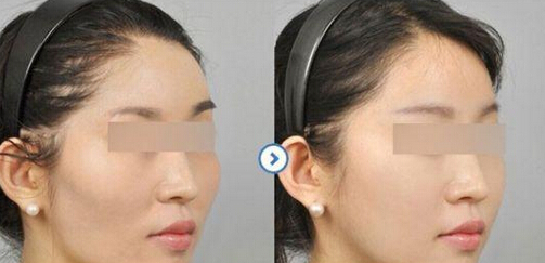 颧骨太高了怎么办才好