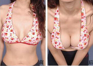 假体隆胸可以做出乳沟吗