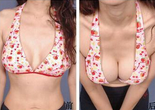 女人隆胸后会变形吗
