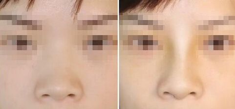 假体隆鼻后怎样快速恢复