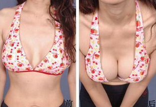 假体丰胸后会不会下垂