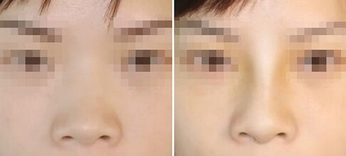 膨体隆鼻会引发感染吗