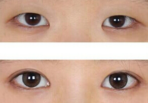 开眼角手术适合哪些人