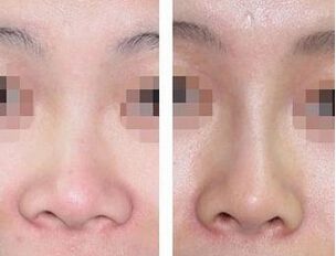 鼻子增高可以注射干细胞吗