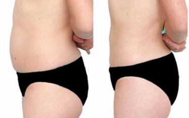 成都男子局部减肥