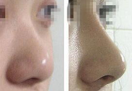 德阳做膨体隆鼻多少钱