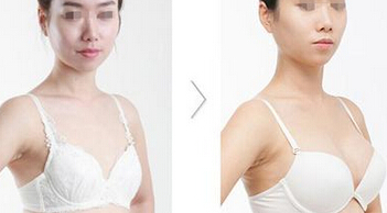 成都极好的隆胸医院